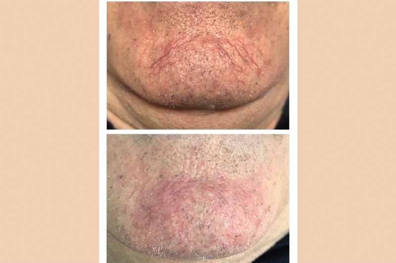 Klinika Venus Center, Kirurgji Dermatologjike me laser ne fytyre, kirurgji & fraxional, LED terapi per aknet dhe rigjenerim, heqje e kapilareve me lazer ne fytyre, ne kembe, per akne, shenja aknesh, rrudha, kapilare, nishanesh